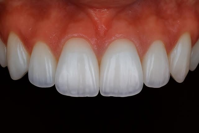 Dentritz — Veneers